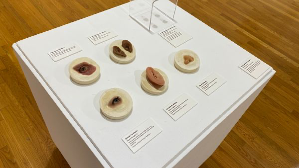 Modern photograph of a display case showing several eye prostheses.